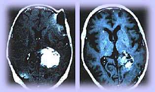Brain scan of both before and after imunotherapy.